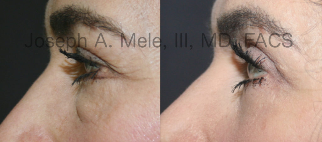 Lower Eyelid Surgery (Blepharoplasty) for Eyelid Bags - before and after pictures