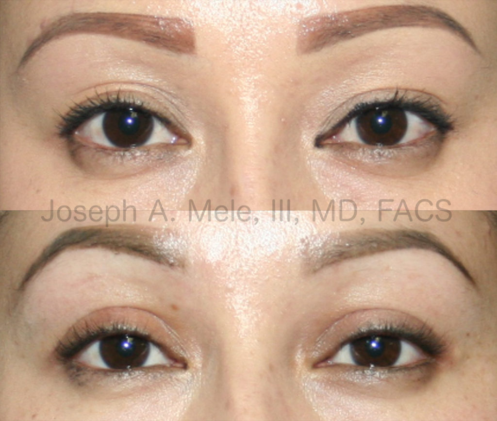 Double Eyelid Surgery can correct low, indistinct or multiple eyelid folds. These double eyelid before and after pictures show how the folds can be raised, sharpened and made more symmetrical.