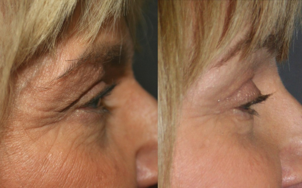 Eyelid Surgery, or Blepharoplasty, shrinks the loose skin than overhangs the upper eyelid and tightens the bags often seen in the lower eyelids.
