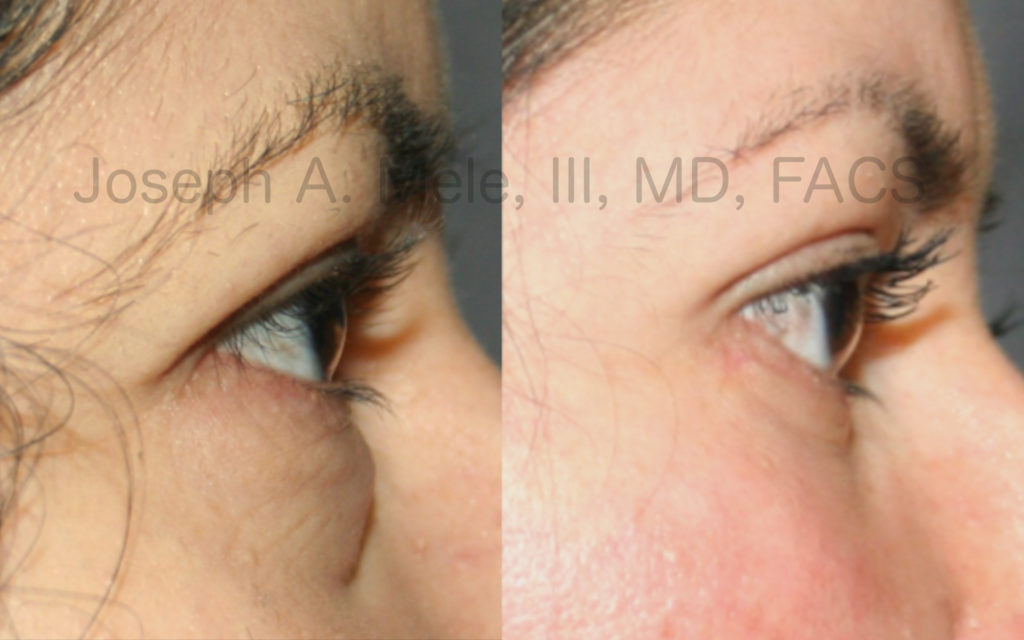 Lower eyelids bags can be corrected with lower eyelid surgery. See these lower blepharoplasty before and after pictures.