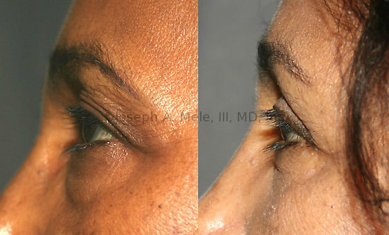 This Blepharoplasty Before and After Photo set shows how eyelid surgery can remove excess upper eyelid skin and lighten baggy lower eyelids.