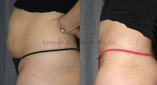 Tummy Tuck (Abdominoplasty) - Before and After Photos