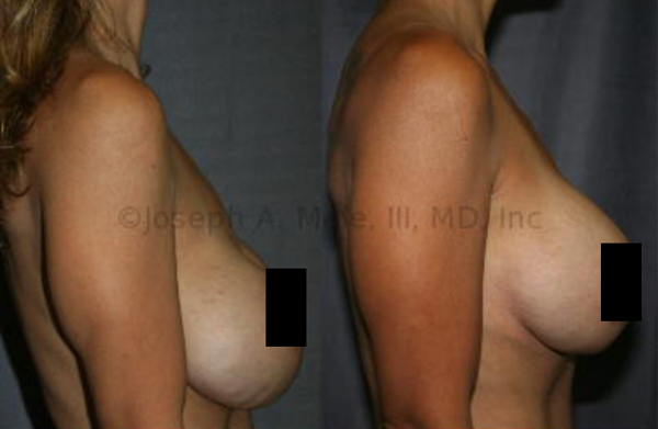 Severe Bottoming-Out: Side view of breast implant revision surgery for severe breast implant inferior malposition and lower pole rippling. Correction was obtained with an internal capsulorrhapy and no addition exterior scars.