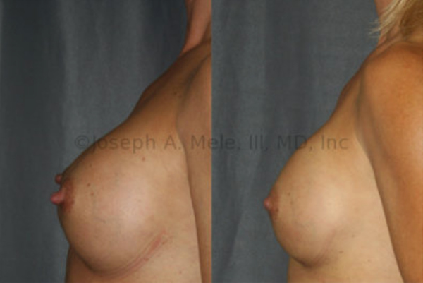 Mild Bottoming Out: Most the volume of the breast implant is below the nipple before the breast implant revision surgery. Note the enhanced fullness above the nipple and the improved angle at the bottom of the breast. Nipple reduction was also performed.