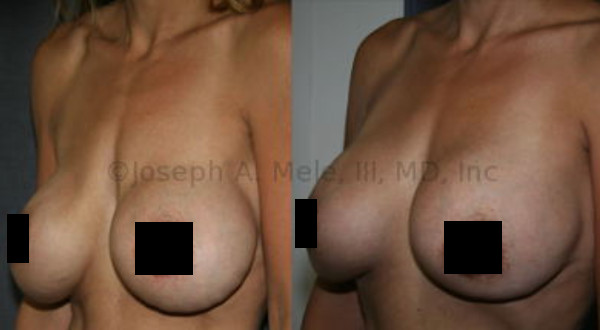 <b>Severe Bottoming-Out</b>: Breast implant revision surgery before and after pictures of the correction of severe bottoming-out with an internal lift. No additional exterior incisions were needed to provide correction.