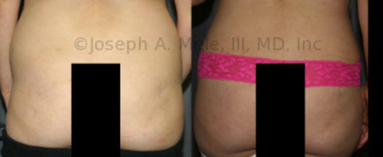 The Brazilian Butt Lift has been on the rise in the US for the last ten years. The technique allows not only for buttocks enlargement, but for reshaping the buttocks. The before image on the left shows square buttocks which are asymmetrical, too full up top and yet empty laterally, especially on the left. The after image on the right shows more shapely female buttocks with a rounder fullness, smooth contours and better symmetry. The end result is  an hourglass figure.