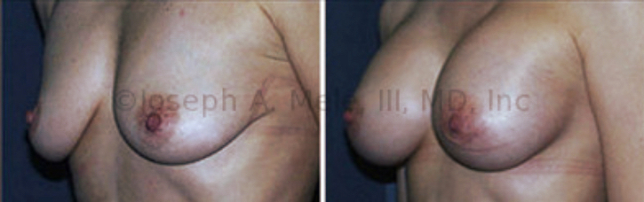 Sometimes Breast Augmentation alone is enough to rejuvenate the postpartum breasts, as demonstrated in the above Breast Augmentation before and after pictures.