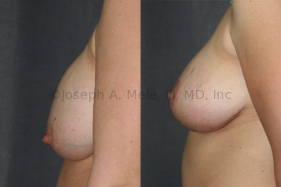 Before: This young woman had Breast Augmentation before pregnancy. After two children, the skin of her breasts relaxed, dropping the breast tissue off her Breast Implants.  After: Her Breast Implants were exchanged to adjust volume and a Breast Lift was performed to reshape and rejuvenate her breasts.