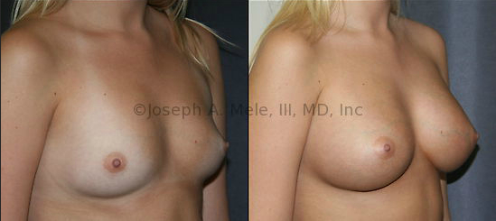 Breast Augmentation advances as New Breast Implant Technology becomes available.