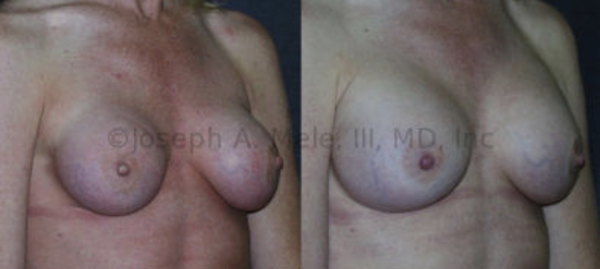 Capsular Contracture results in a compressed breast implant that looks, smaller, feels harder and in the worst case scenario hurts. A capsulectomy and breast implant exchange was performed to provide this patient with softer, larger, painless breasts that look and feel better.