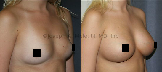 Saline or Silicone? Saline and Silicone Breast Implants feel different, but give similar results visually.