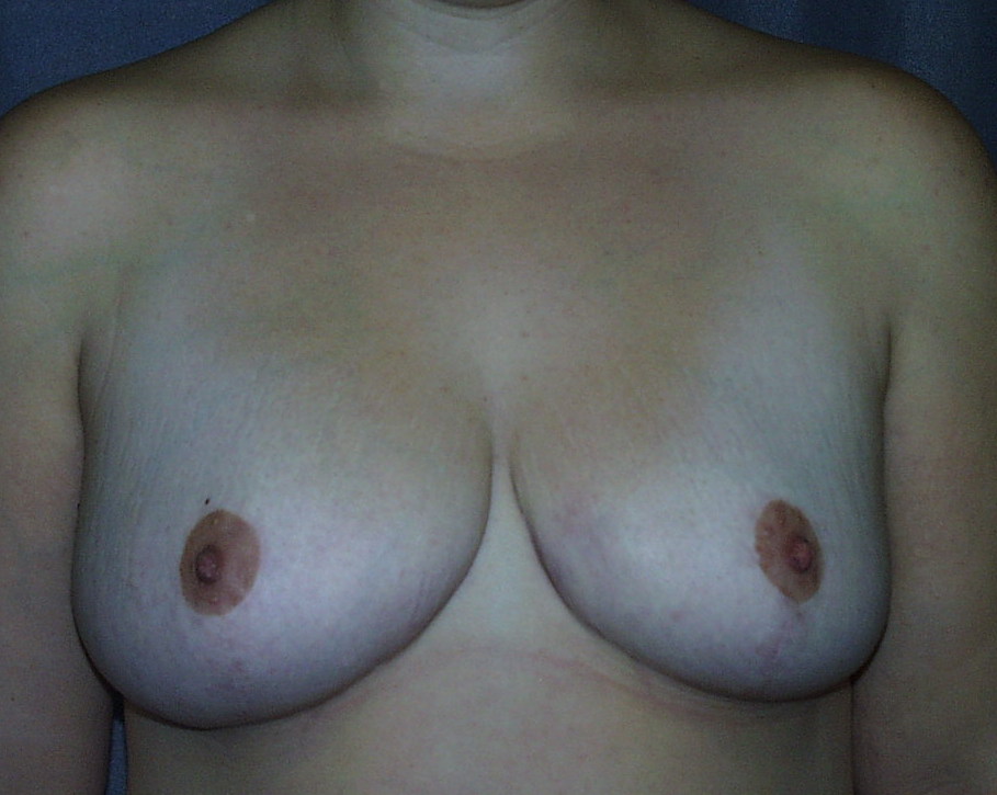 Breast Lift with Breast Reduction After Picture