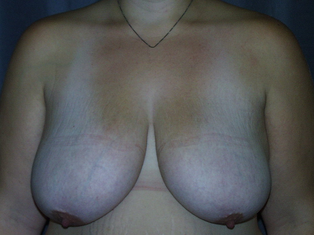 Breast Lift with Breast Reduction Before Picture