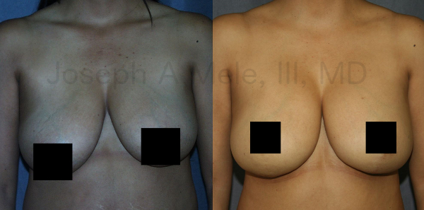The Inverted-T breast lift gives the maximum lift and improvement, and have the longest scars too.
