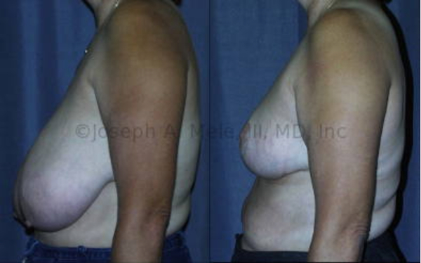 Breast Reduction Before and After Pictures illustrating the typical goals of reduced size and lifted breasts.