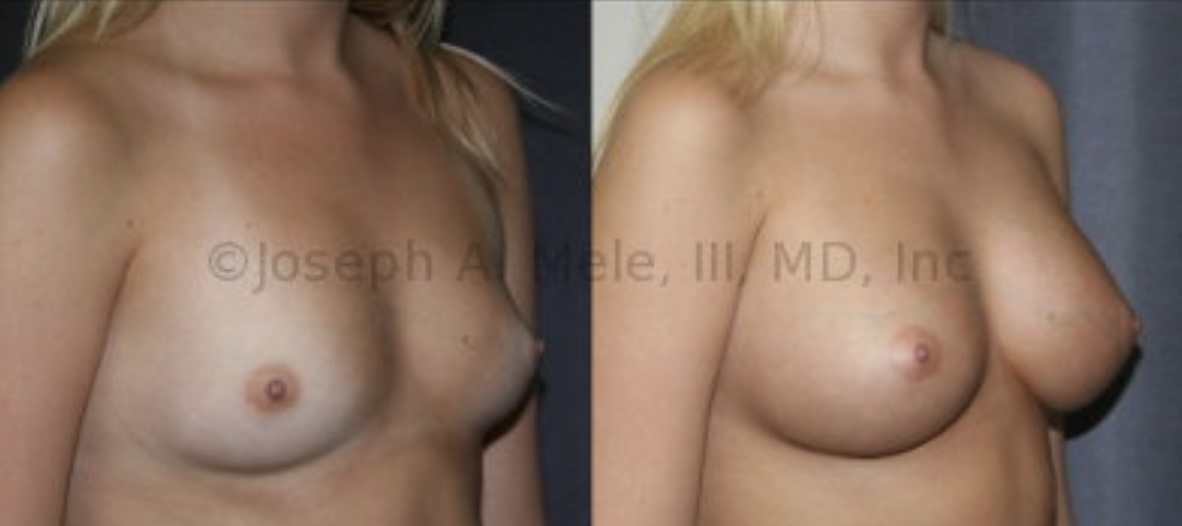 Breast Implants enlarge the shape you already have. The Breast Augmentation before and after pictures above show Breast Augmentation without a Breast Lift.