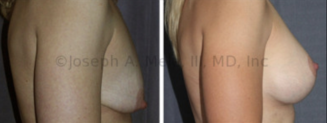 The Breast Augmentation Mastopexy before and after pictures above show what is possible when Breast Implants are used with a Breast Lift. Correction of both size and shape is possible.
