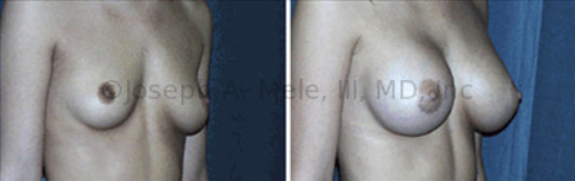 Breast Augmentation can help with pseudoptosis and  asymmetry. The breasts appear bottomed out before surgery, with most the breast volume located below the nipple and mild pseudoptosis. The Breast Augmentation before and after pictures above show how Asymmetrical Breast Augmentation can correct the shape of the breasts and the size discrepancy. In this case, the right breast was smaller than the left before surgery, so a larger Breast Implants was used on the right.