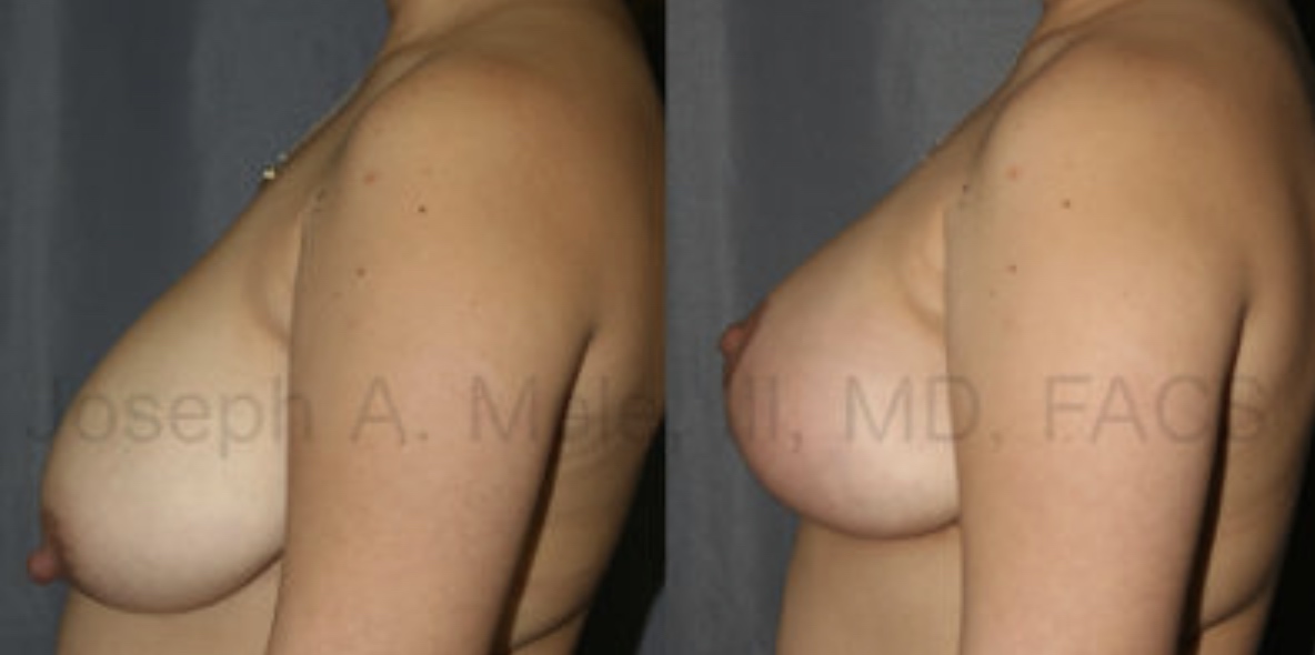 When the breast volume is good, but the breast needs a lift, Breast Lifts can help. The Breast Lift (Mastopexy) before and after pictures above show how the breast can be reshaped without adding volume.