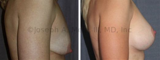 The main goal of Cosmetic Plastic Surgery is a pretty result. The Breast Augmentation Lift allows for control of both the size and the shape of the breasts. The cost is additional scar. In this case, an Inverted-T scar was needed.