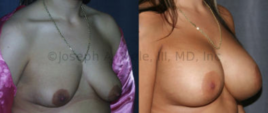 The Breast Augmentation and Breast Lift combination with the smallest scar is the Periareolar Mastopexy Augmentation. An incision around the areola is used to raise the nipple and insert the Breast Implant. In the above case, the flattening effects of the periareolar lift are exploited to help reshape these tubular (tuberous) breasts.