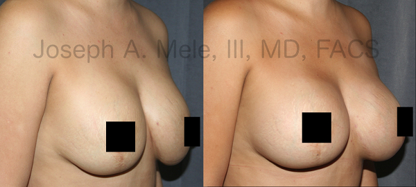 The most common reason for Breast Augmentation Revisions is to go bigger. This is especially common after pregnancy with preexisting breast implants as shown above.