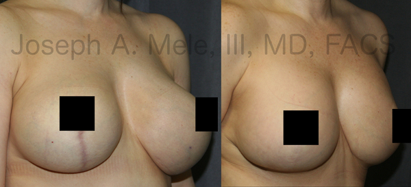 The above Breast Augmentation Revision pictures demonstrate the correction of bottoming out. 