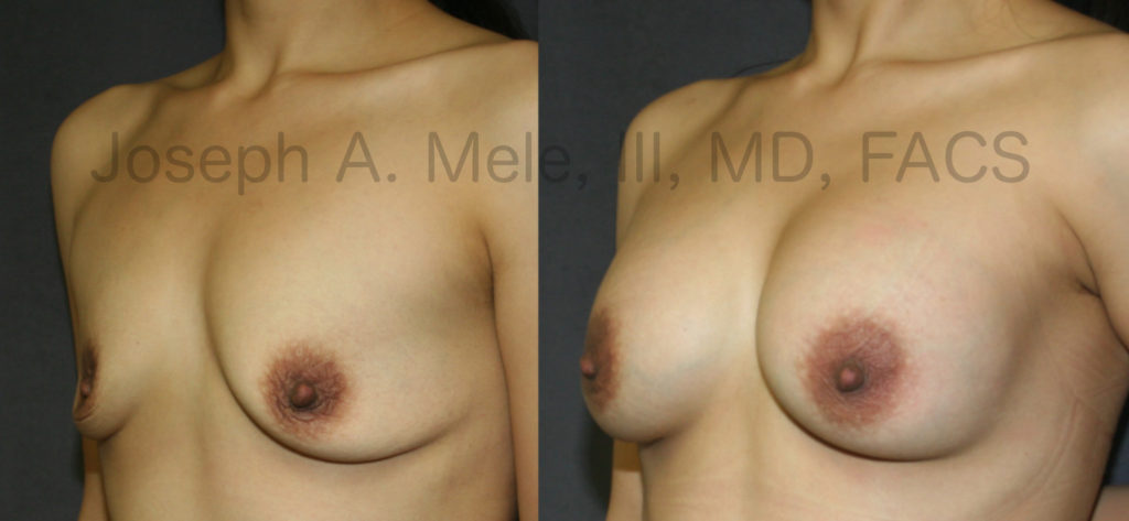 The Breast Augmentation before and after photos above show how Breast Implants alone add back the volume lost with pregnancy and breastfeeding. A breast lift, in this case a Periareolar Breast Lift, could have been used to both reduce the areolae and bring the nipples a little higher on the chest, but the result is good, and there is no additional scarring around the nipple.