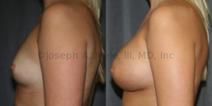 The woman above passes the pencil test. She has no sagging, so Breast Augmentation with Breast Implants is all that is needed to enlarge her breasts.