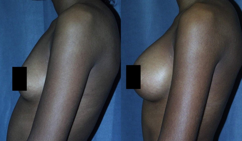 Breasts that have always been small have an advantage when it comes to Breast Augmentation.