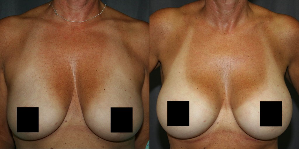 Breast pseudoptosis or "fake sagging" responds well to Breast Augmentation.