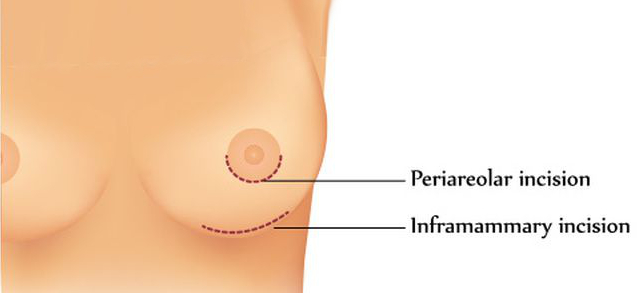 The most frequently used Breast Augmentation incisions are the periareaolar incisions and the inframammary incisions as shown above
