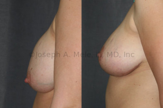 This patient had breast augmentation prior to becoming pregnant. <strong>Left:</strong> After pregnancy, the breast implant position remains unchanged; however, the breasts have dropped. <strong>Right:</strong> After breast augmentation revision, the breasts have been lifted and the breast implants exchanged, dramatically improving the breasts' shape and profile.