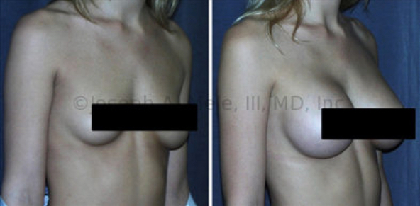 Breast Augmentation before and after photos: Breast Augmentation remains one of the most popular cosmetic plastic surgery procedures. In the above photos, asymmetry, sagging and upper pole emptiness are corrected with Breast Implants.
