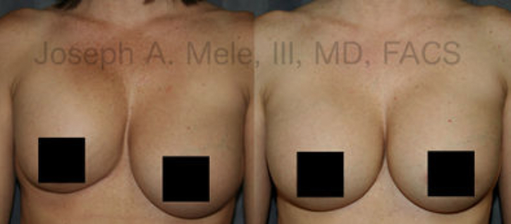 Capsular Contracture is tightening of the scar pocket that holds the breast implant in place. In the left before-photo, Capsular Contracture elevates this patient's right breast implant and causes severe asymmetry. The right after-photo shows correction after capsule surgery and breast implant revision surgery. Now, Capsular Contracture is covered by all three US FDA approved manufacturers' warranties. 