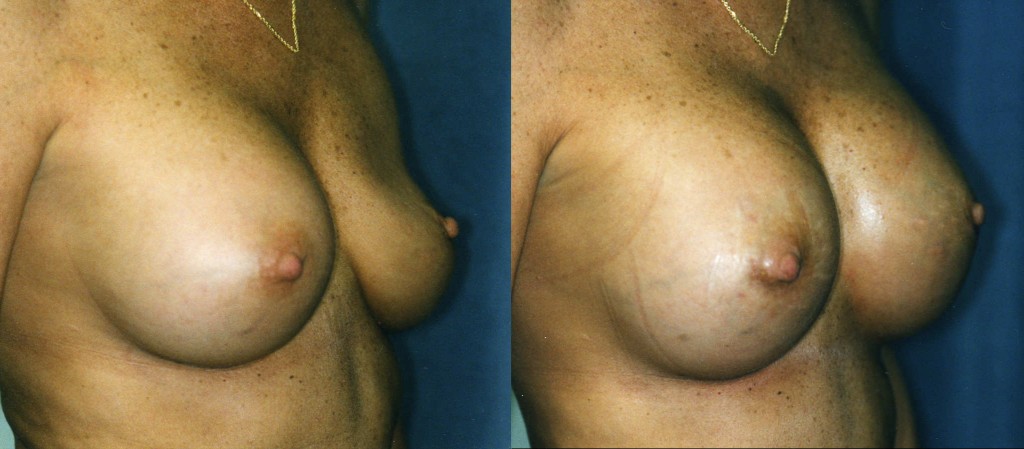 Breast Implant Deflation and Replacement