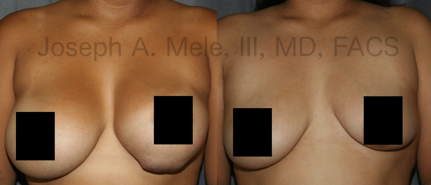 Breast Augmentation Revision - Stage I was urgent removal of the left breast implant, which had nearly eroded its way through the lower pole of the breast. It was elected to remove both implants during stage I, because replacing the original saline breast implants with smaller silicone gel filled breast implants was part of the plan to decrease the risk of recurrence.