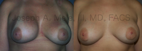 Breast Implant Malposition