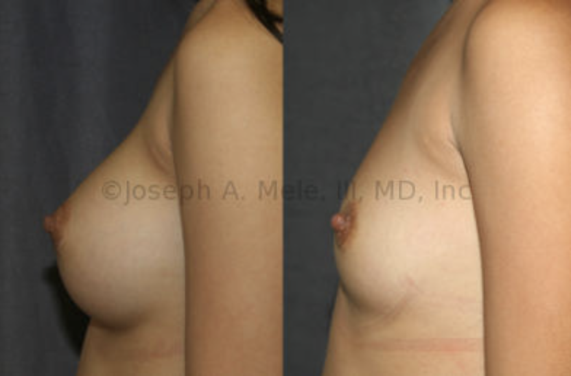 Breast Implant Removal Before and After: This patient has great breast skin elasticity, so she has no skin sagging after her Breast Implant Removal. Breast Implant Remova surgery is just as personal as Breast Augmentation surgery, and the reasons for it vary. Only 1% of all Breast Augmentation patients have their Breast Implant removed.