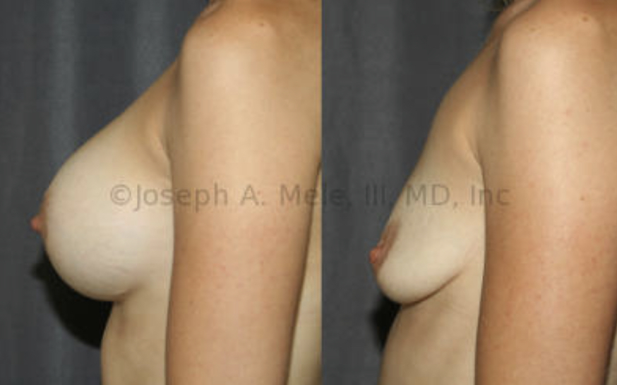 Breast Implant Removal Before and After Photos: Larger implants and less native breast tissue increase the desire for a Breast Lift after Breast Implant Removal Surgery. This patient  above had large volume breast implants, small natural breast tissue volume, but good skin tone and nipple placement. She elected not to have a Breast Lift.