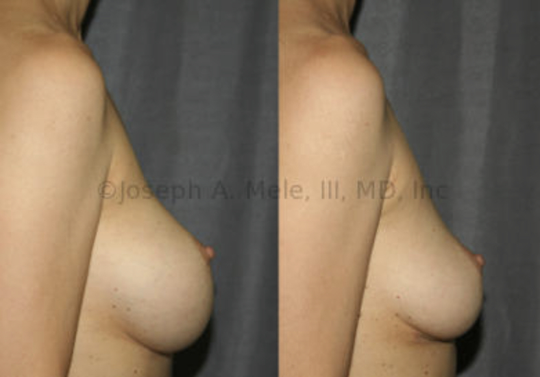 Breast Implant Removal Before and After Pictures: The patient above wanted her Breast Implants removed because she felt too big. She also has some bottoming-out of her breast implants. Her breast implants were removed and a special, inferior-pole lift was performed to reduce the amount of skin hanging below her nipple and to move the native breast tissue that she had back up under the nipple.