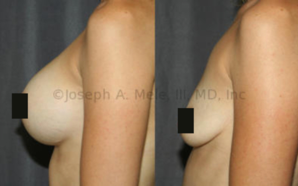 Breast Implant Removal Before and After Pictures - Side View