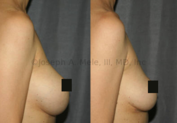 Breast Implant Removal With Breast Lift Before and After Pictures - Side View