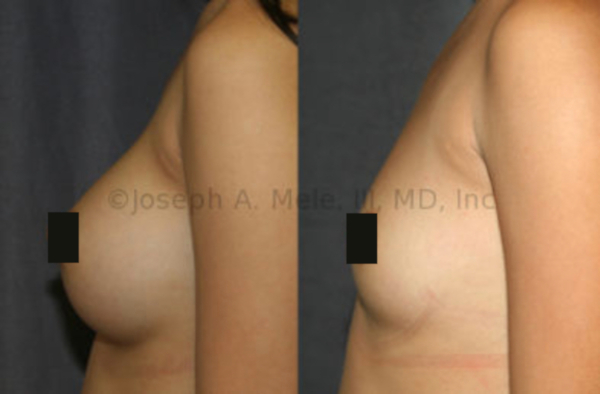 Breast Implant Removal Before and After Pictures - Side View