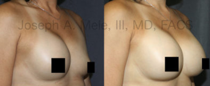 These Breast Implant Rupture Before and After photos illustrate a common case of Breast Implant Revision Surgery. The coverage is variable and depends on the manufacturer.