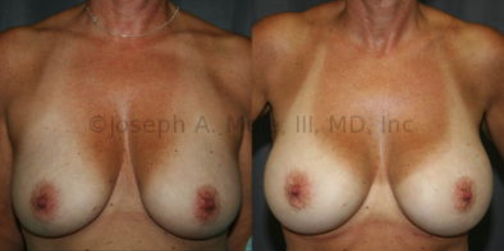 The woman above fails the Pencil Test, but passes the Pinch Test.  Breast Implants alone can correct this type of "Fake" sagging or pseudoptosis.