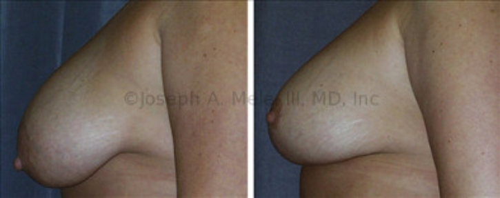 The woman above fails the Pencil Test. Since her nipples are lower then the fold under her breasts, she also fails the Pinch Test (as described below) and needs a Breast Lift to provide the best aesthetic result.