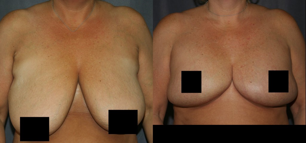Breast Reduction surgery reduces the size and the discomfort associated with large breasts.