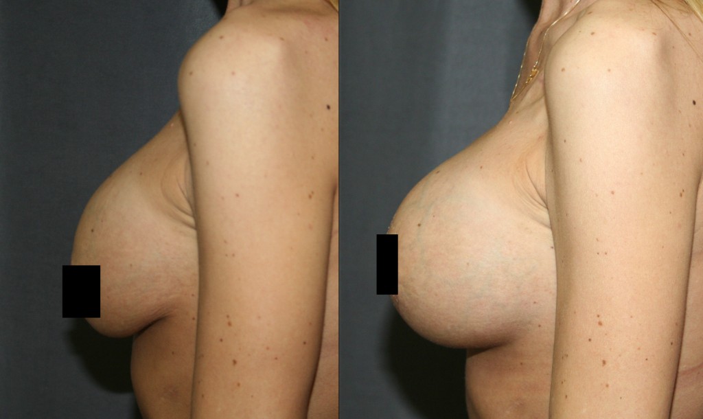 A common reason for Breast Implant Revision is to correct  Capsular Contracture. Before, the  breast implant is firm, squeezed and pushed up out of the breast by a tight capsule, leaving the breast tissue hanging. The after picture shows the improved breast shape and support.