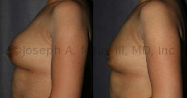 Breast Implant Removal Before And After Photos: One option is to have the breast implants removed and not replaced. Another is to replace your PIP breast implants with FDA approved breast implants, the later options will also preserve the size of your breast. Be certain to ask your Board Certified Plastic Surgeon about your options for treatment.